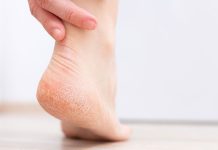 This Winter, Follow These Easy Home Remedies To Prevent Cracked Heels!